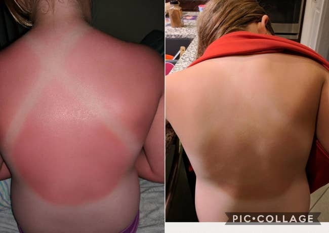 A reviewer's back sunburnt in the shape of a bathing suit back on the left / the same back with completely faded burn