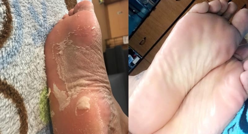 A reviewer before photo of feet peeling while using Baby Foot, and on the right, the same reviewer, showing how smooth their feet are after