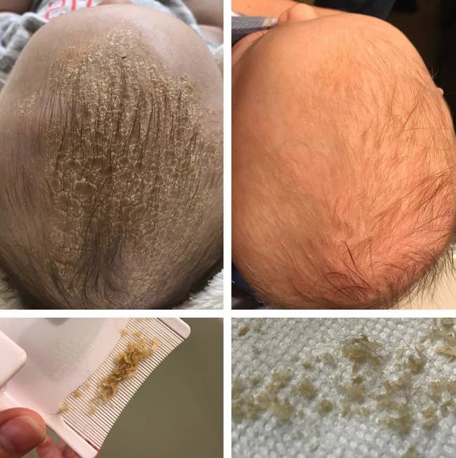 A reviewer's baby's head with dry scales on the left and the same baby's head looking smoother and flake-free on the right / the comb filled with flakes and the flakes sitting on a paper towel on the bottom