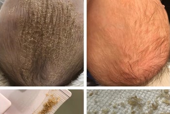 A baby's head with dry scales on the left and the same baby's head looking smoother and flake-free on the right