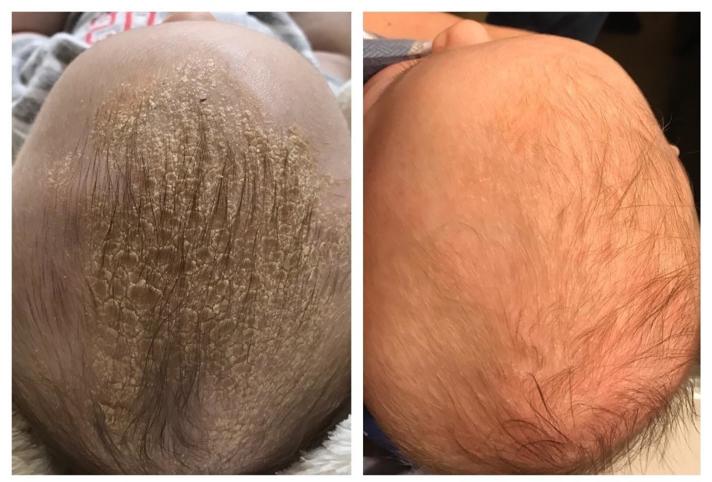 A baby's head with dry scales on the left and the same baby's head looking smoother and flake-free on the right