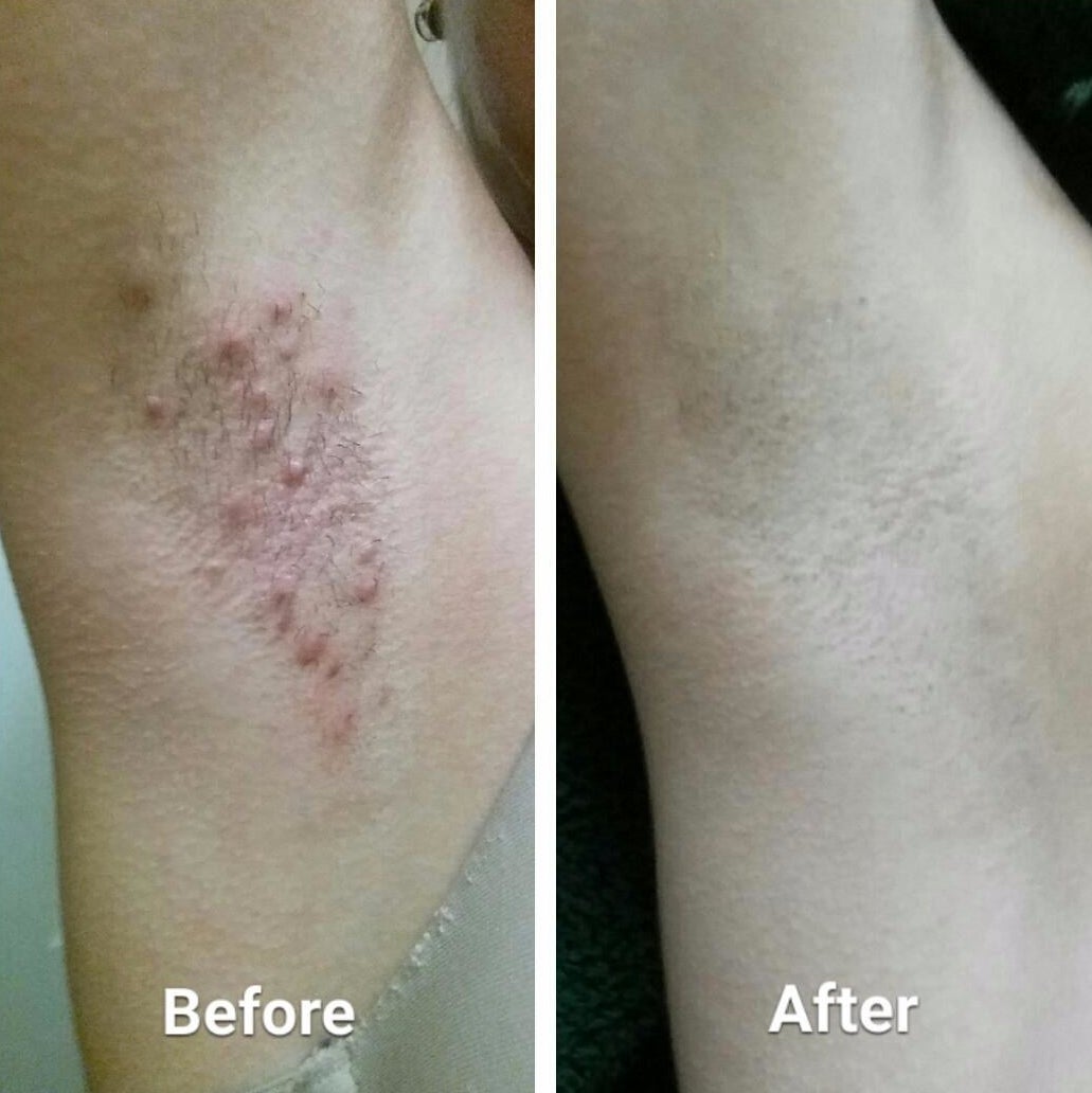 a reviewer&#x27;s armpit before: covered in razor burn and after: smooth with no redness or bumps