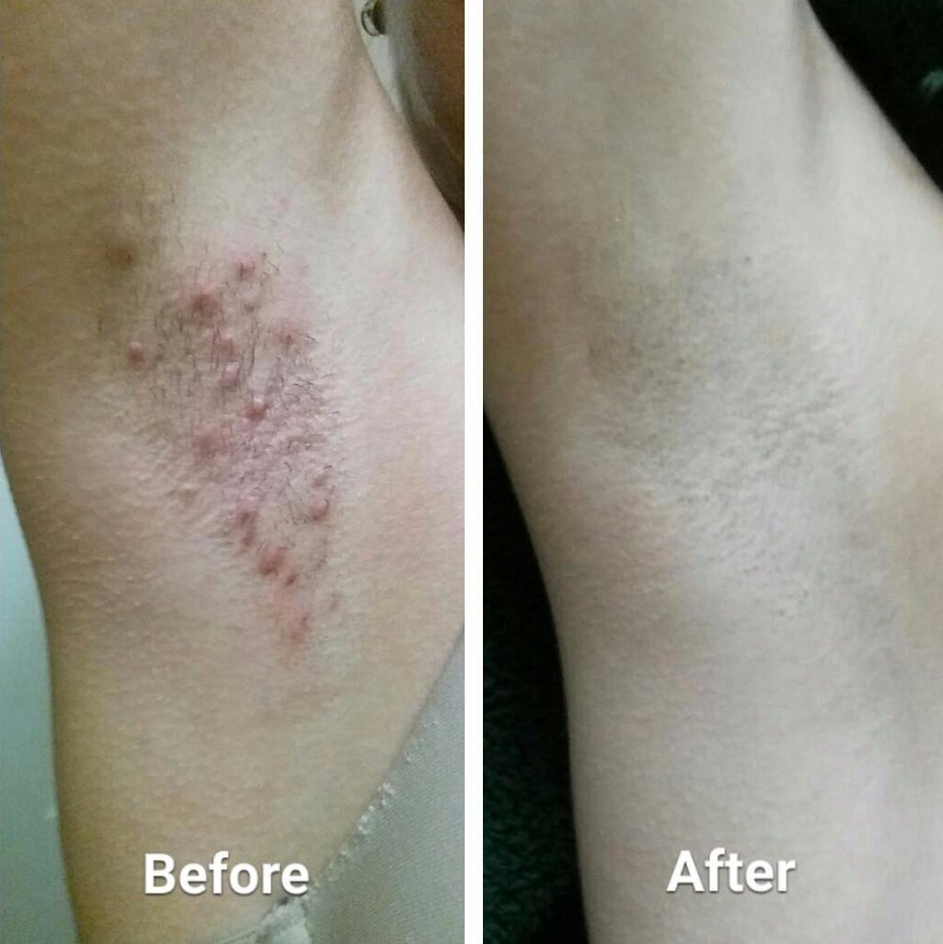 Before: An underarm red and bumpy with razor burn; after, the same underarm, now razor-burn free