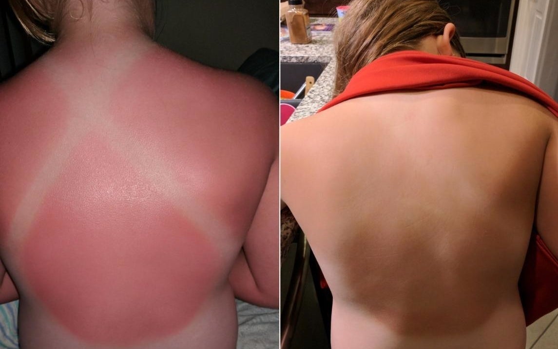 Before: A reviewer with a very sunburned back except for lines where their swimsuit covered; After: the same reviewer, the sunburn faded, but you can still faintly see the swimsuit lines