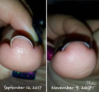 Reviewer before and after photo showing an ingrown nail corrected with the brace 