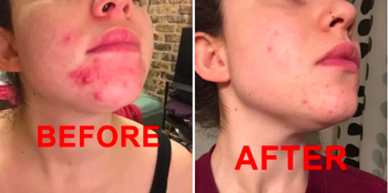 before and after showing the clay dramatically reduced the appearance and redness of breakouts on a reviewer's chin and jaw