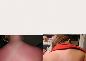 Reviewer's before and after photos showing a sunburn on the back and a back without the sunburn after using the lotion