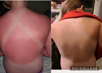 Reviewer's before and after photos showing a sunburn on the back and a back without the sunburn after using the lotion