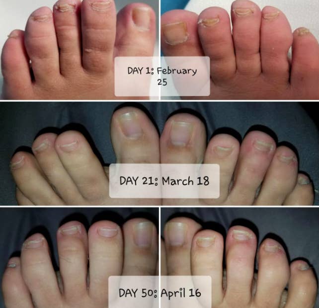A before, during, and after photo of a reviewer&#x27;s toes looking healthier and fungi-free while using the solution