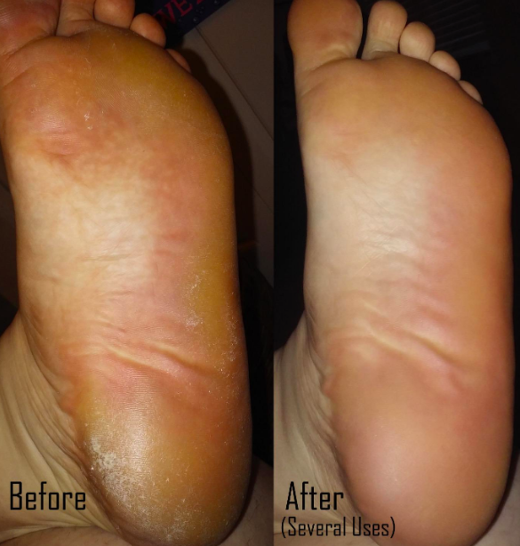On the left, a foot looking calloused and dry, and on the right, the same foot looking smooth and soft after using the the remover several times