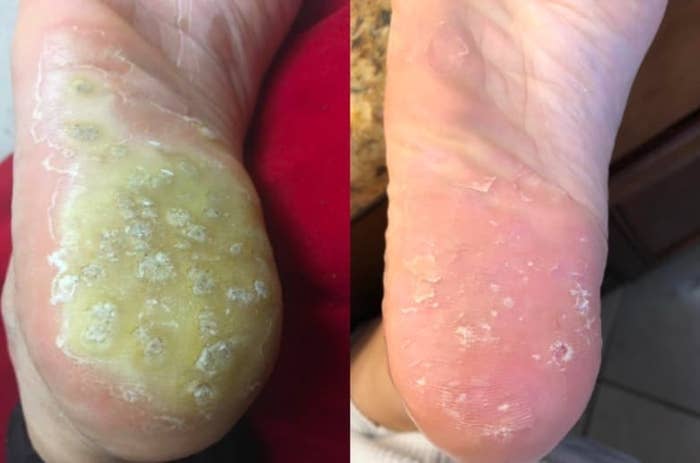 On the left, a before photo of a foot with a plantar wart, and on the right, the same foot with the plantar wart almost gone
