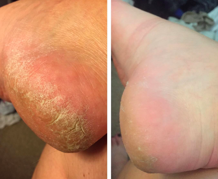 split callus on foot