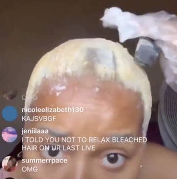 A Teen Accidentally Livestreamed Her Hair Falling Out On Instagram