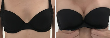 Brastop.com - #FridayFitTip - are your bra cups too small? Take a look at  this before and after of a 32DD vs a 30FF! 🍉🍉 While the 32DD (top) may  look like