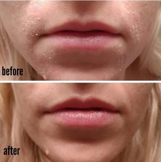 Reviewer&#x27;s before and after picture of their face with dry patches, and then clear