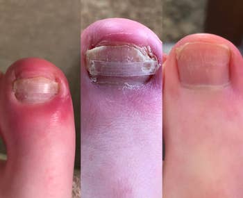 A customer review photo showing their toe before, during, and after using the treatment