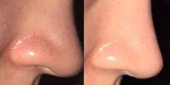 Reviewer&#x27;s before and after of their nose with blackheads and then clear 