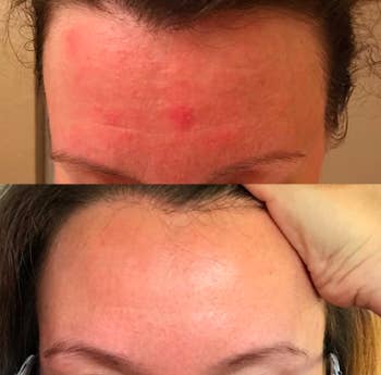 A customer review photo showing their forehead before and after using the derma roller