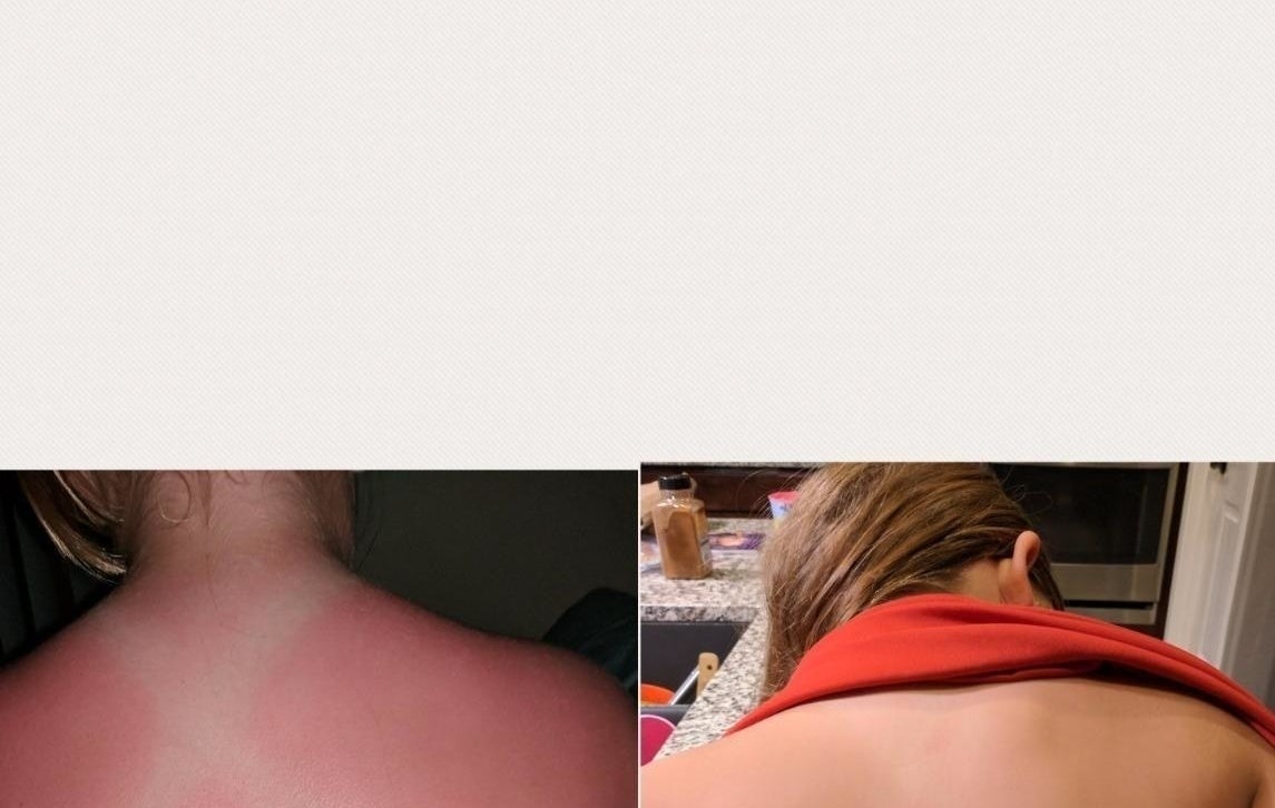A reviewer&#x27;s before and after: before, their back hot pink from sunburn; after, their back faded to a tan 
