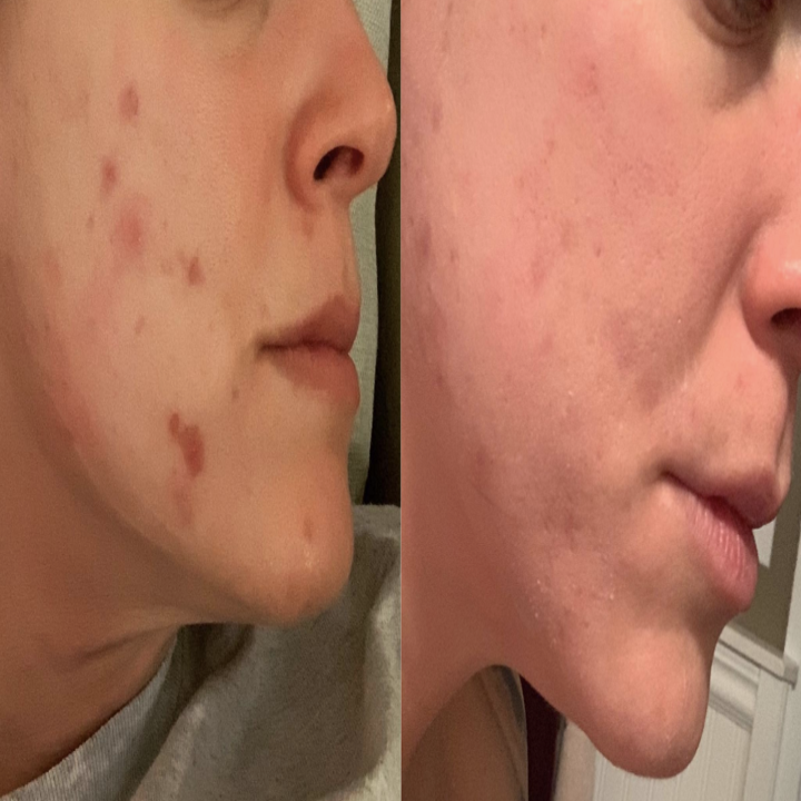Reviewer photo of before and after using the pimple patches, showing how it reduced the redness and decreased the size of the pimples