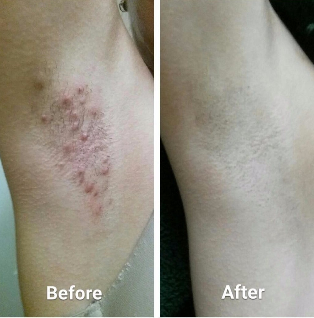 A reviewer&#x27;s before photo showing their irritated underarms with red bumps, and their after photo where the red bumps are eliminated