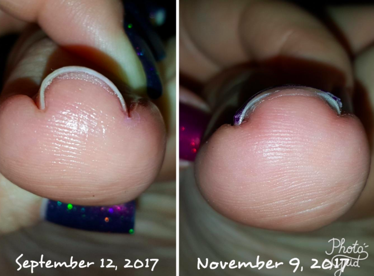 A reviewer&#x27;s before photo dated 9/12/17, showing a curved toenail, and their after photo dated 11/9/17 (two months later), and their toenail has straightened out
