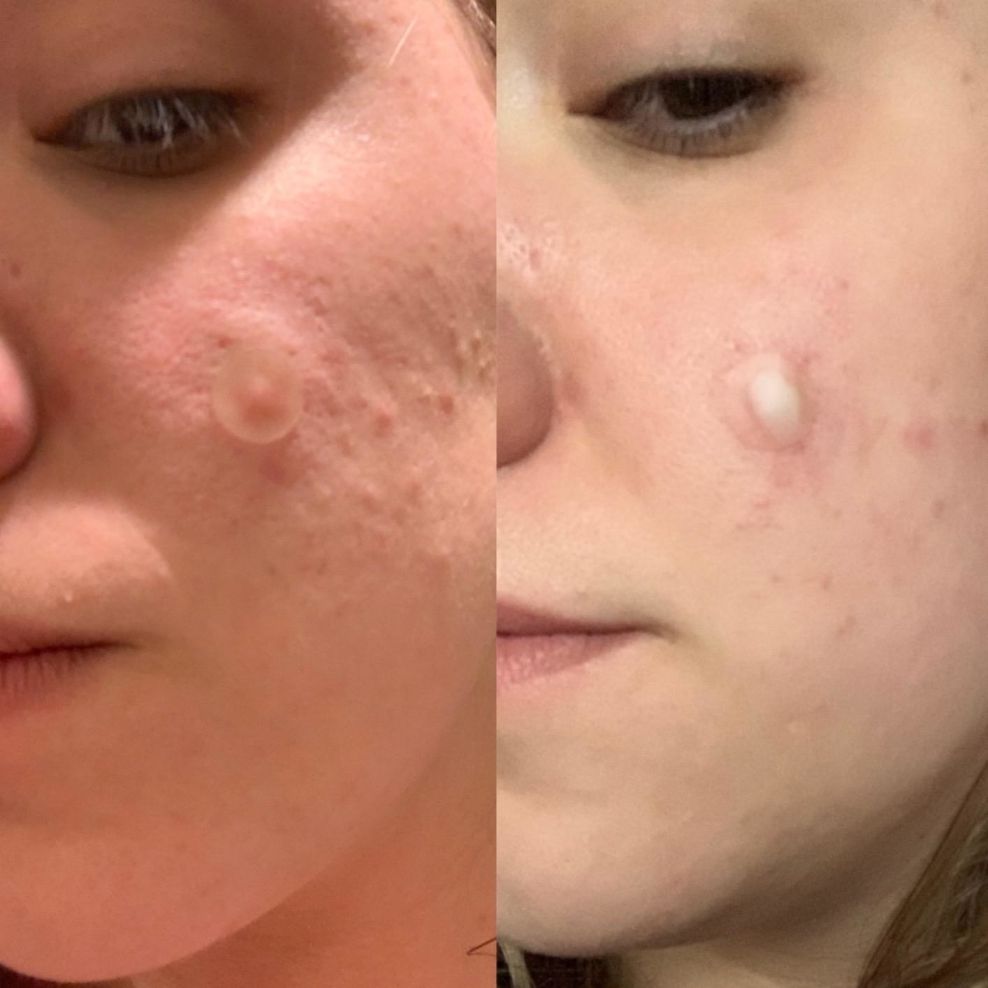A reviewer with a patch on their zit, and their &quot;after&quot; photo showing the patch has absorbed a bunch of white gunk