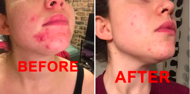 Reviewer photo showing face before and after using the mask. The before photo shows lots of breakouts and redness and the after photo shows very few breakouts and little redness