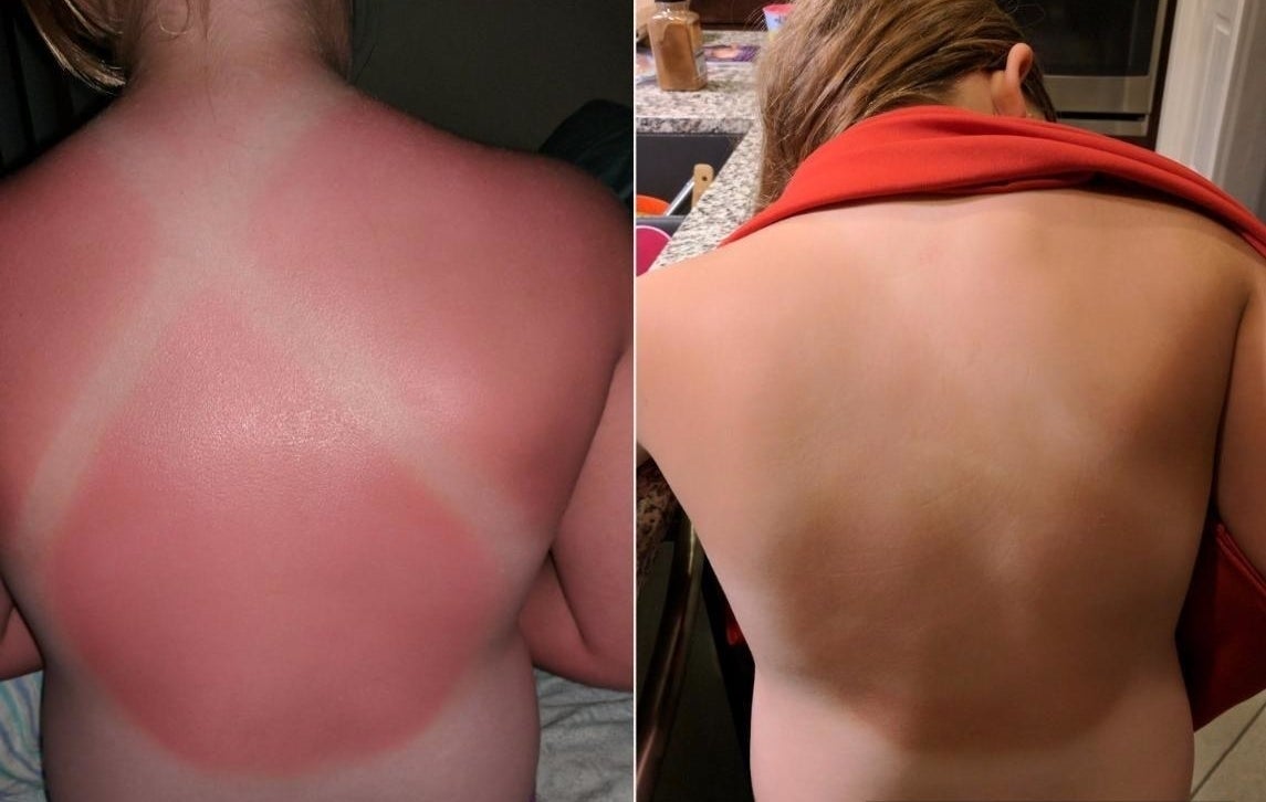 Review photos showing a sunburned back before and after using the lotion. The before photo shows red, inflamed skin and the after photo shows same skin with redness 90% gone