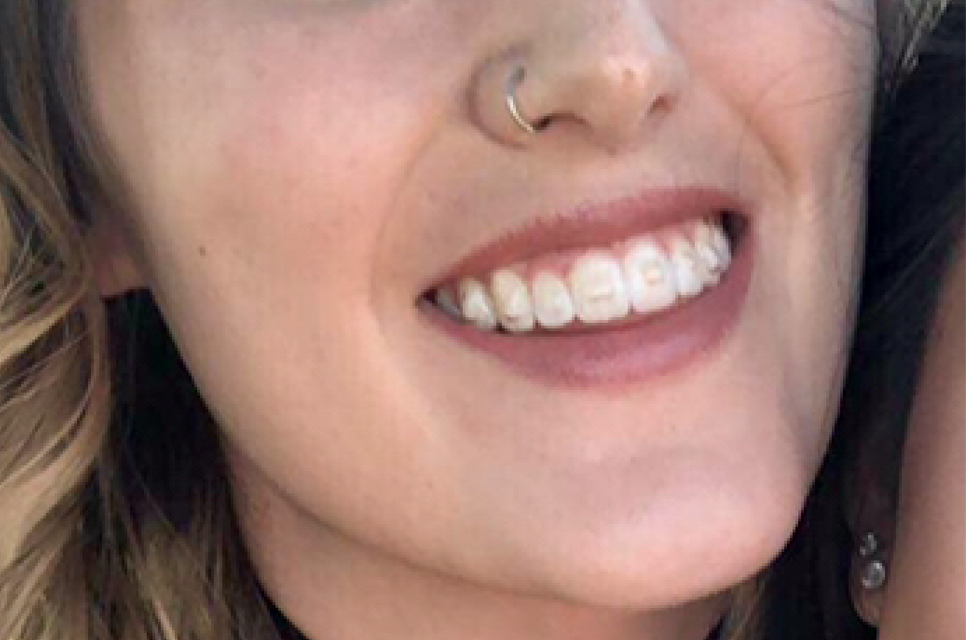 invisalign with bands