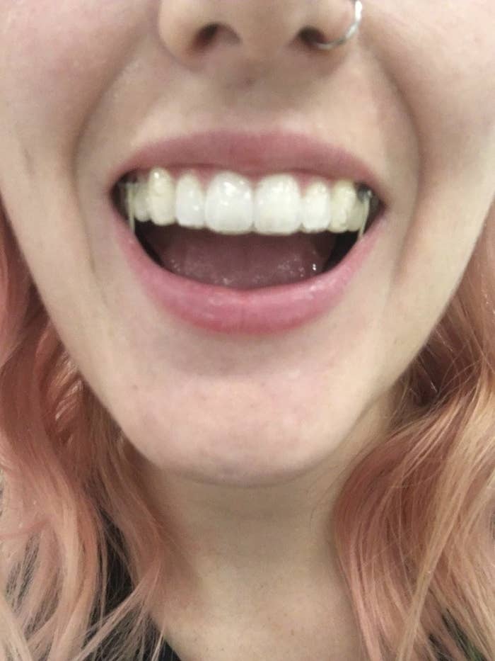 invisalign journey reddit