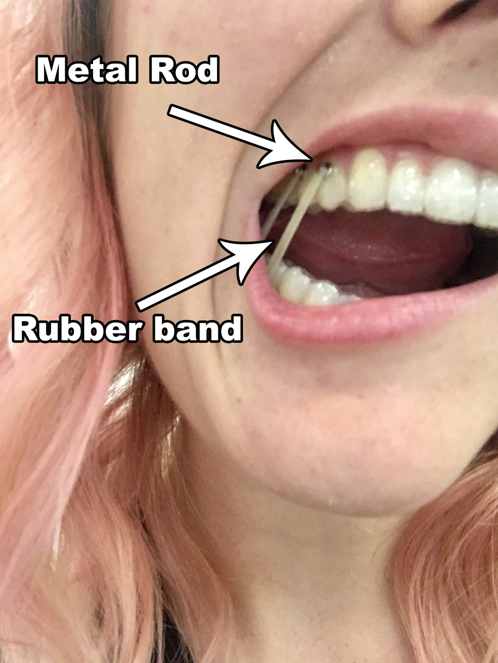 invisalign with bands