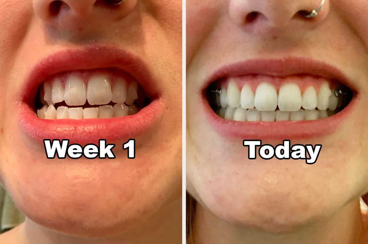 Invisalign Review: I've Had It For Two Years And Here's Everything I've  Learned