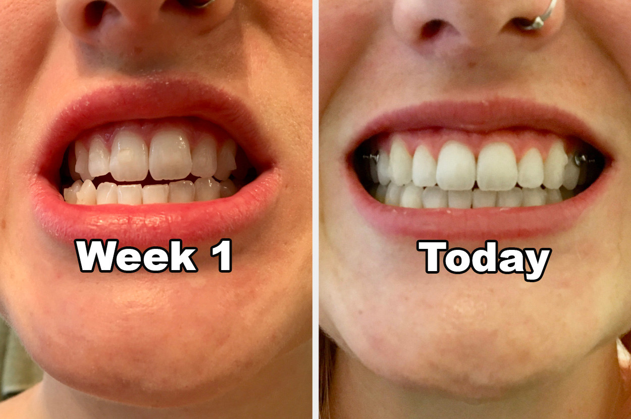 invisalign journey reddit