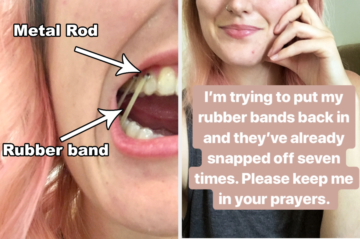 Are braces rubber bands used with Invisalign too?