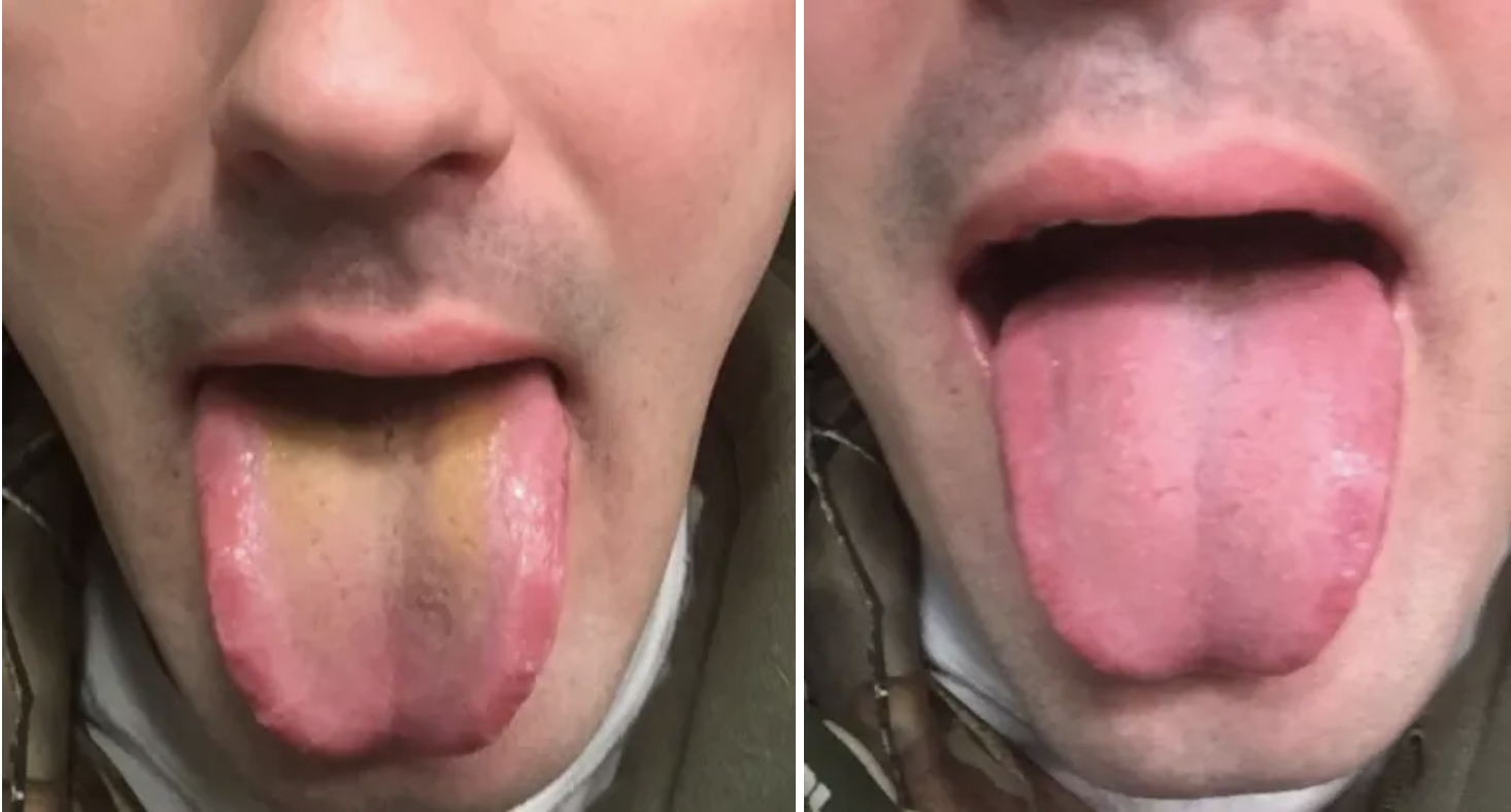 Left: a reviewer&#x27;s tongue with yellowish residue on it. Right: the same tongue, but clean and pink