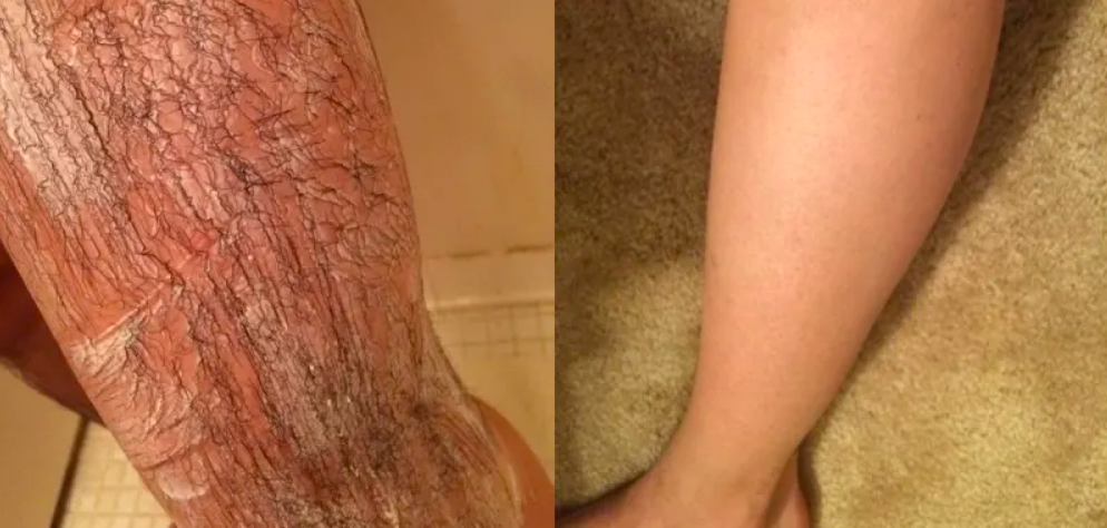 A reviewers leg covered in long, dark hair after lathering on the cream and a photo of their leg after, totally hairless 