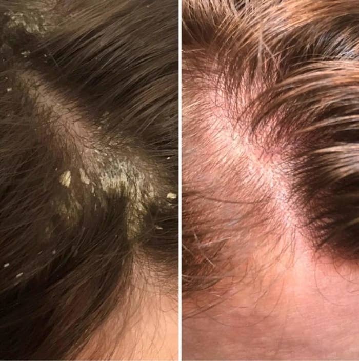 On the left, a reviewer&#x27;s scalp with dandruff in it, and on the right, the same reviewer&#x27;s scalp without any dandruff in it