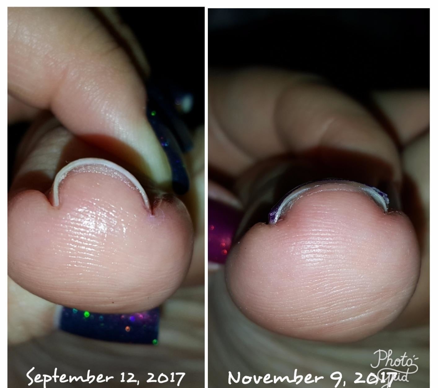 On the left: a reviewer's ingrown toenail on September 12, 2017; on the right: the toenail much much, much less ingrown on November 9, 2017