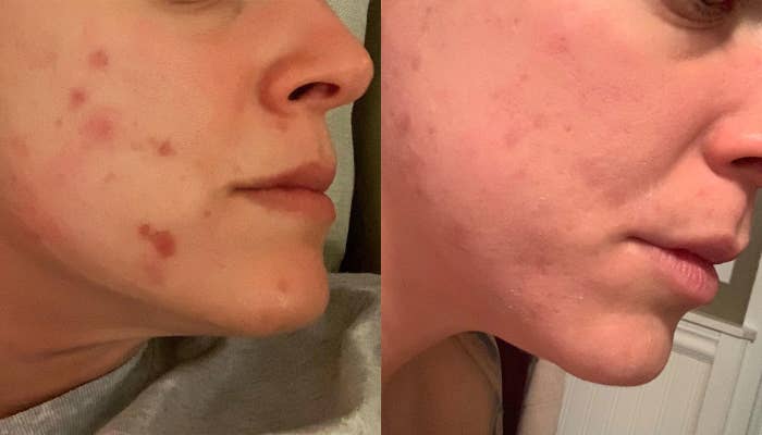 A reviewer with some acne spots on their cheek on the left, and the acne gone (with just some residual marks) on the right