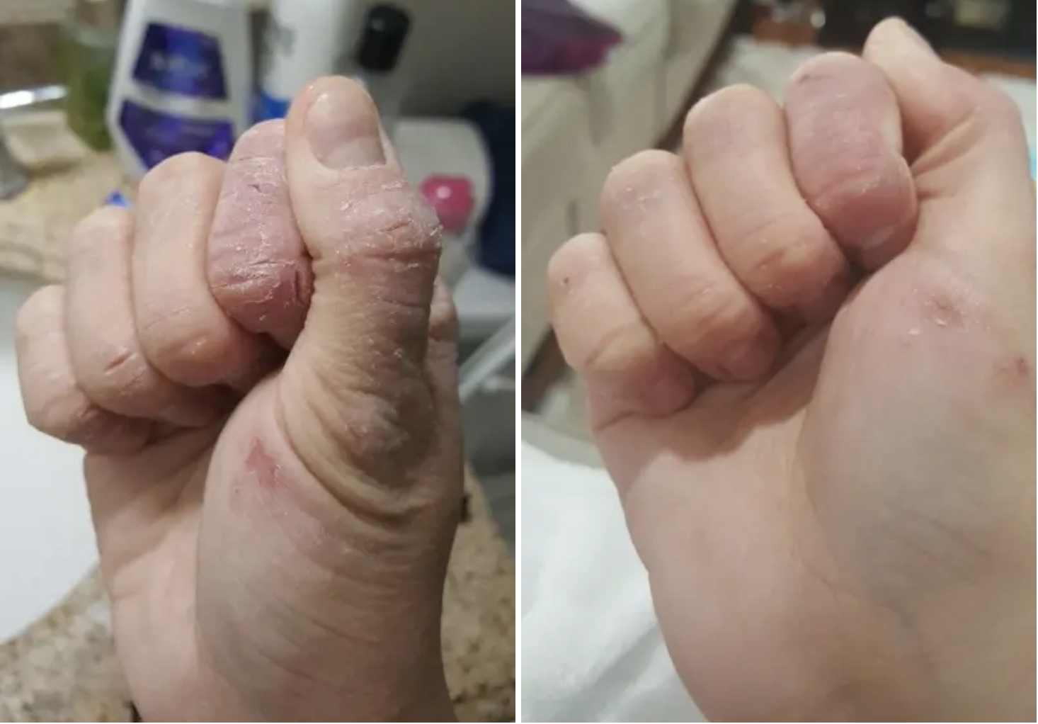 Cracking, dry hands on the left, and the same hands on the right almost completely healed