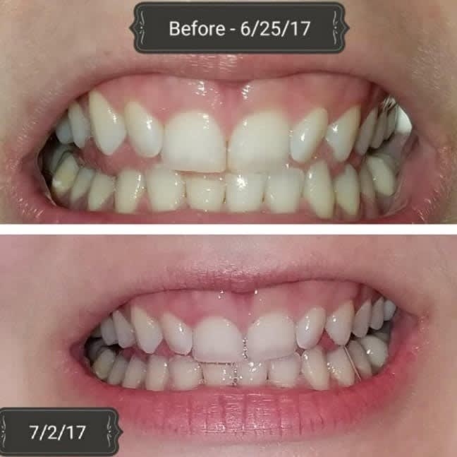 On the top, a reviewer&#x27;s teeth looking a little yellow, and on the bottom, the same reviewer&#x27;s teeth looking whiter just a week later
