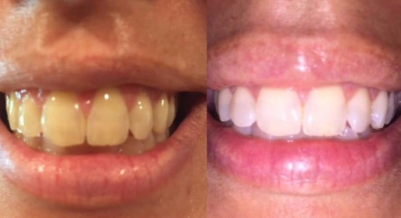 On the left, a reviewer&#x27;s teeth looking yellow, and on the right, the same reviewer&#x27;s teeth looking whiter