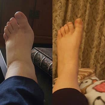 Pregnant reviewer showing the socks dramatically reduced the swelling in their leg and ankle