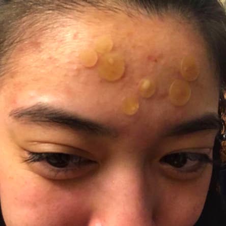 A reviewer with seven pimple patches (both large and small) on different blemishes on their forehead. Some of the transparent patches have started to fill up with goo