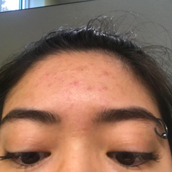The reviewer's forehead with some remaining flat-ish red spots and small bumps but no major pimples