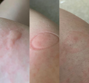 a photo set displaying a person's arm before and after using the bug bite thing