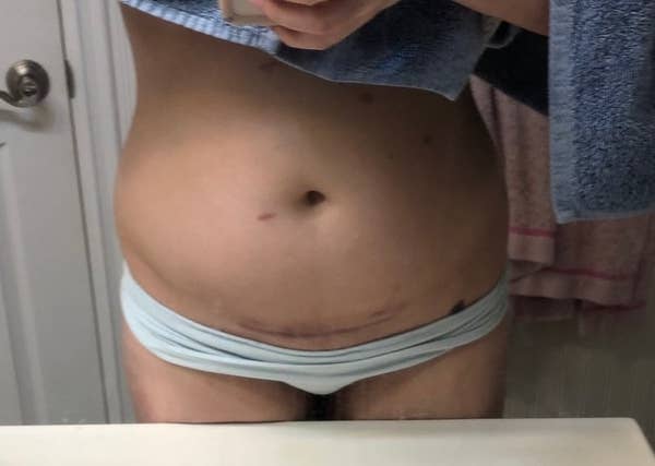 16 Moms Opened Up About What C Section Births Are Really Like And