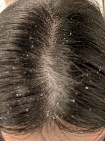 reviewer photo of their scalp with dandruff and product buildup flakes
