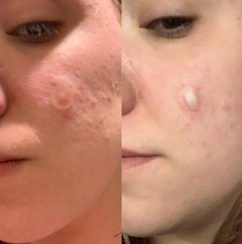 Reviewer's before and after showing puss drawn out from the pimple spot where a patch was placed